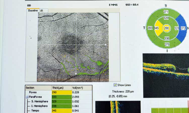 OCT of the eye reveals faint epimacular membrane and full thickness macular hole involving the fovea, surrounding diffuse macular oedema showing few cystoid changes for follow up