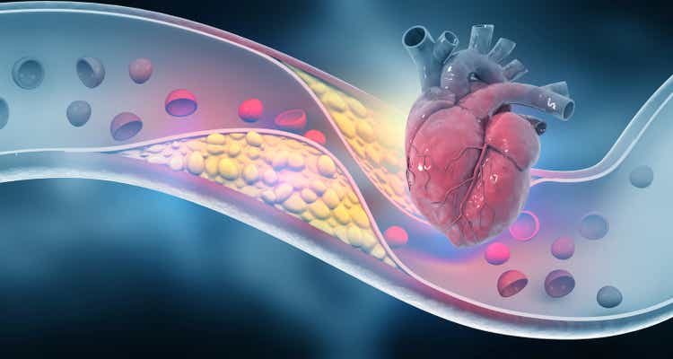 Human heart with artery blocked cholesterol