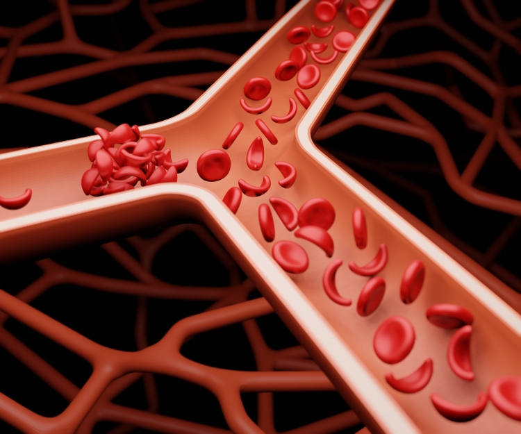 bluebird bio gene therapy lovo-cel for sickle cell disease has $3.1M cost