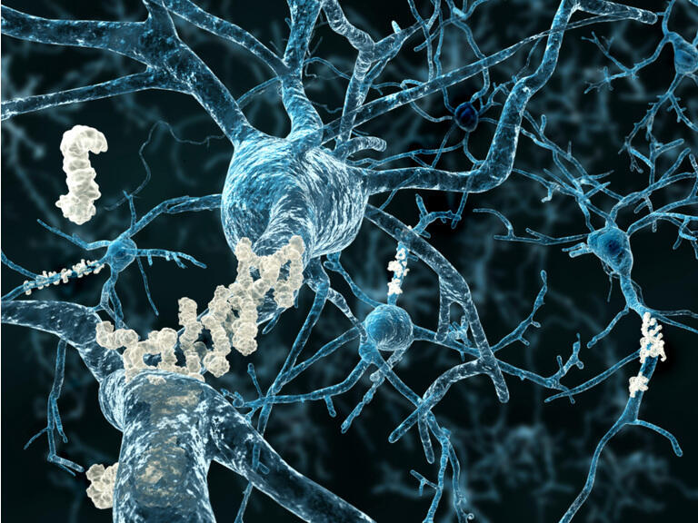 Alzheimer"s disease - neurons with amyloid plaques