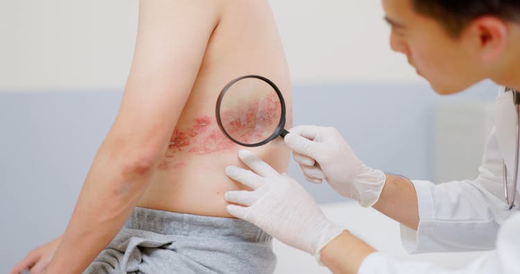 doctor examine shingles disease