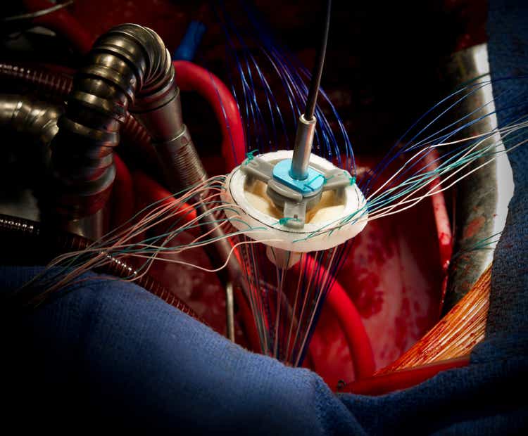 Mitral Valve Replacement Heart Surgery