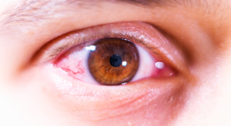 Detail shot photo of irritated brown eye, dry eye symptoms, visual health issue