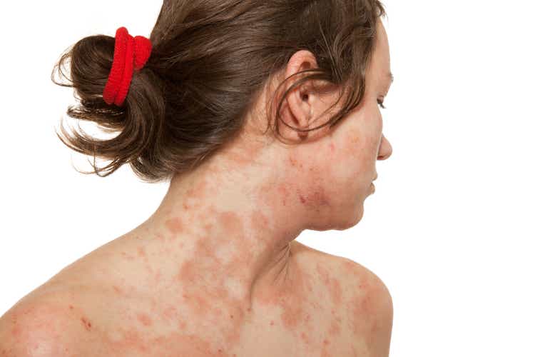 A woman with a skin disorder of atopic dermatitis