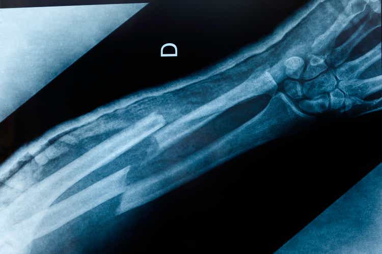 broken arm x-ray