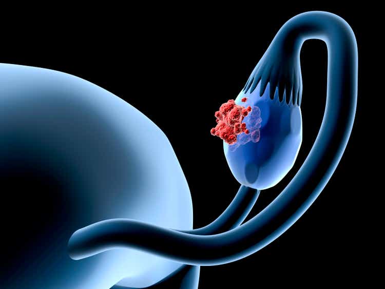 Ovary cancer