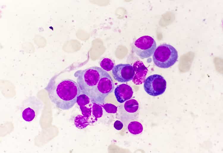 Microscopic view of bone marrow slide showing Multiple myeloma, also known as myeloma, is a type of bone marrow cancer.