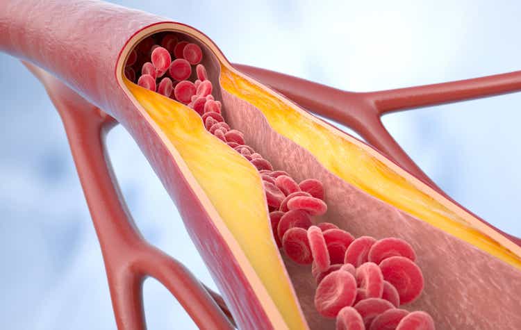 NewAmsterdam Pharma: A Mispriced Bet On A Cholesterol Revolution ...