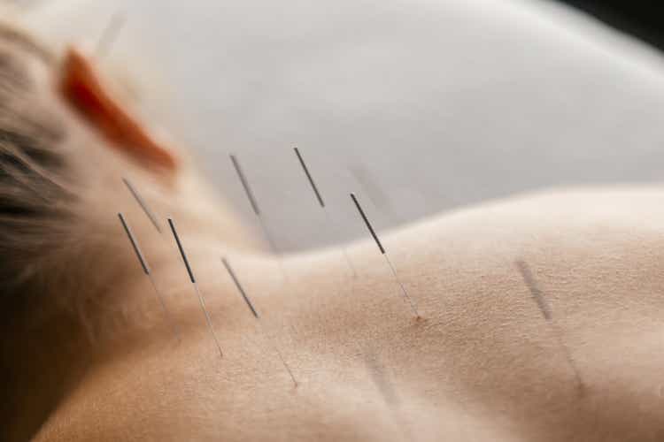 Patient getting acupuncture back treatment