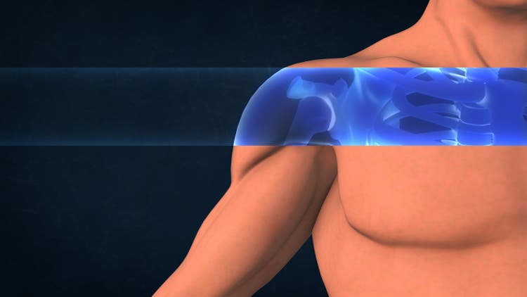 An X-ray of a human shoulder.