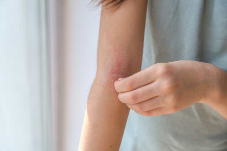 a girl scratches the skin on the elbow of her arm, redness is atopic dermatitis, the girl s face is not visible