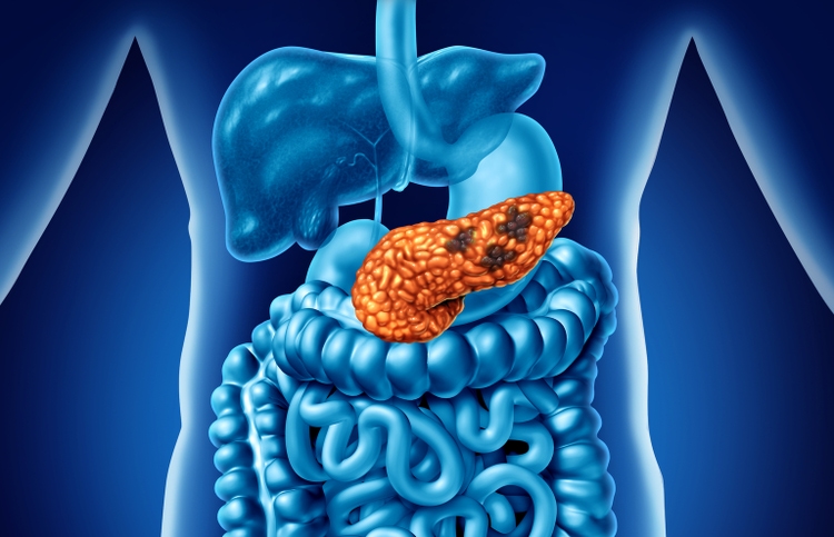 Human Pancreatic Cancer