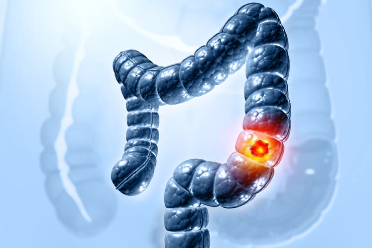 Colon cancer. Cancer attacking cell. Colon disease concept. 3d illustration