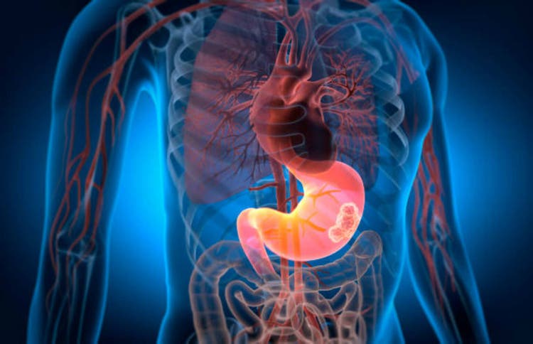 Stomach Cancer - 3D Illustration
