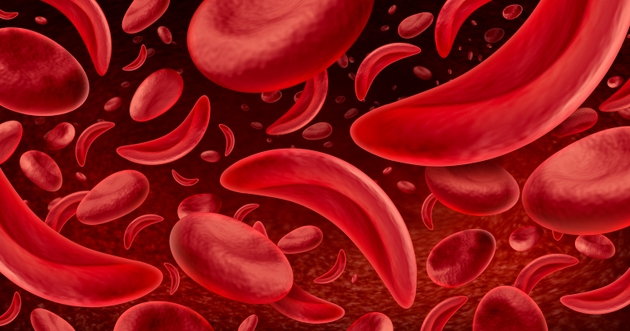 Agios posts mixed trial data for sickle cell therapy (AGIO) | Seeking Alpha
