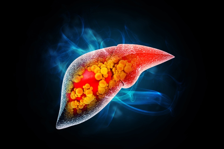 Liver damage such as Fatty liver, Fibrosis, Cirrhosis, and Liver cancer. 3d illustration