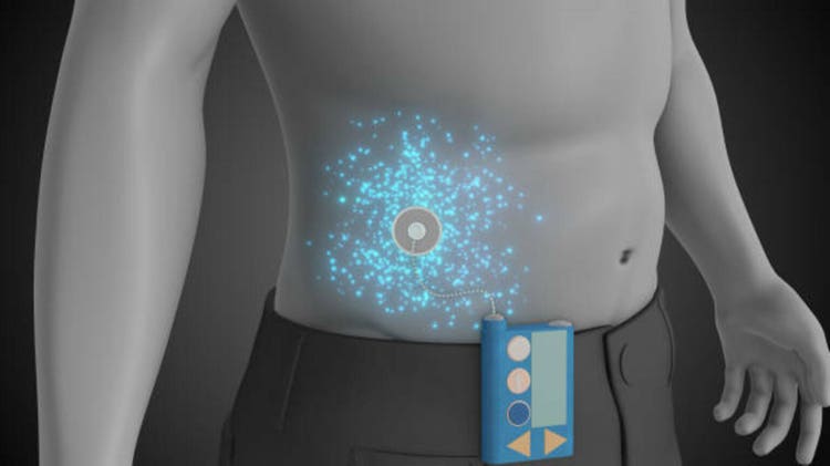 Insulin Pump Regulates Blood Glucose Levels Continuously