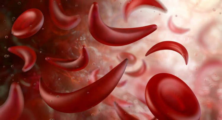 Sickle cell anemia. Deformed red blood cells within the bloodstream.