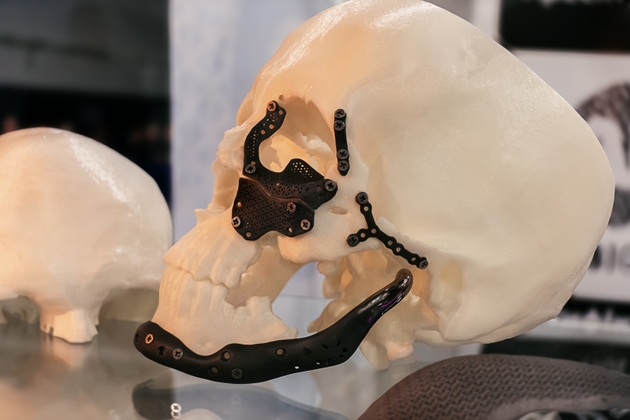Orthopedic implants and individual titanium cranioplasties printed on a 3D printer.