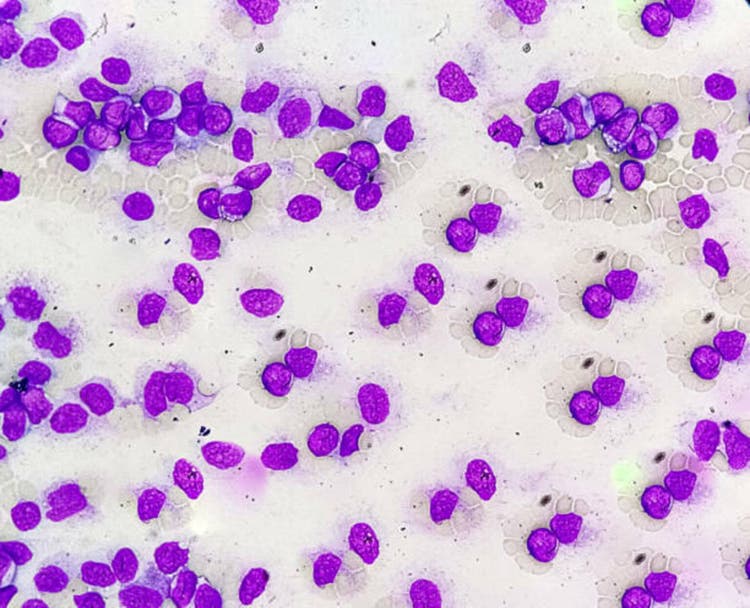 Acute myeloid leukemia (AML) is a type of blood cancer. Microscopic examination of blasts or leukemia cells in blood smear of human.