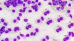 J&J touts phase 1 data for bleximenib for acute myeloid leukemia article thumbnail