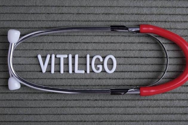vitiligo - text from white letters on green background with stethoscope, medical concept diagnostics, treatment.