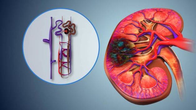 Nephron Damage Leading to Kidney Function Impairment