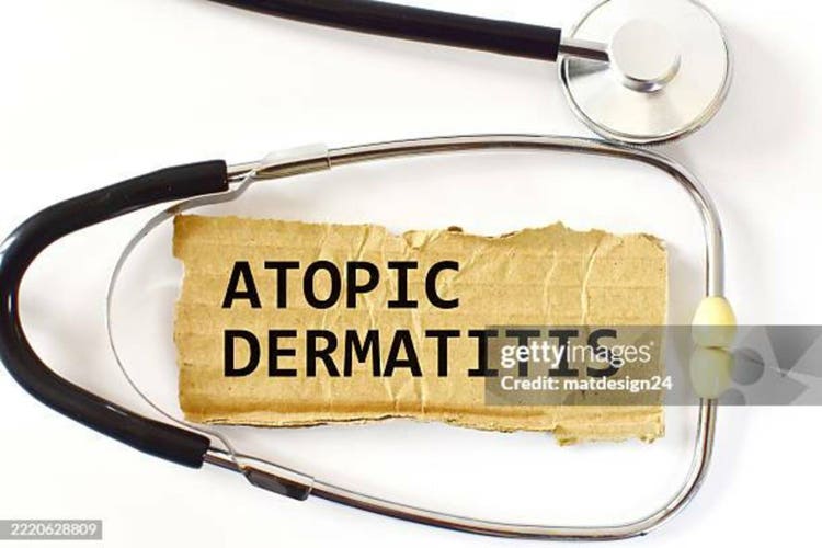 Atopic dermatitis