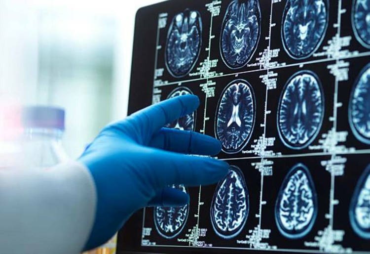 Brain scan image with a doctor"s hand, representing medical diagnosis and research.