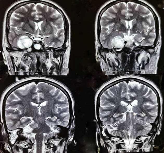 Magnetic resonance imaging (MRI) or CT scan of the brain, sinusitis, sinonasal mass, brain tumours. Metastasis.
