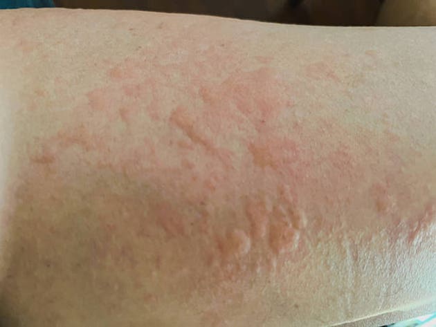 Novartis gains UK approval of Rhapsido for urticaria