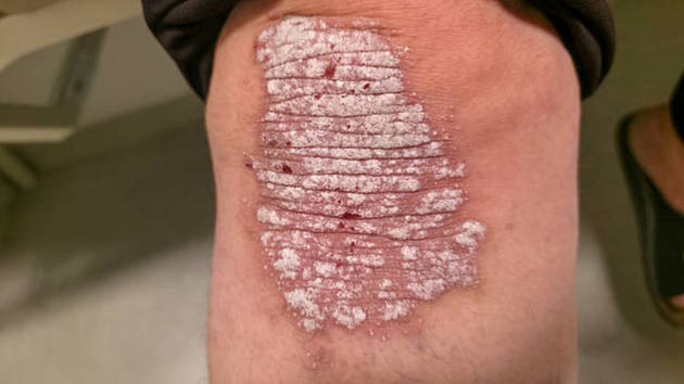psoriasis plaque on the knee
