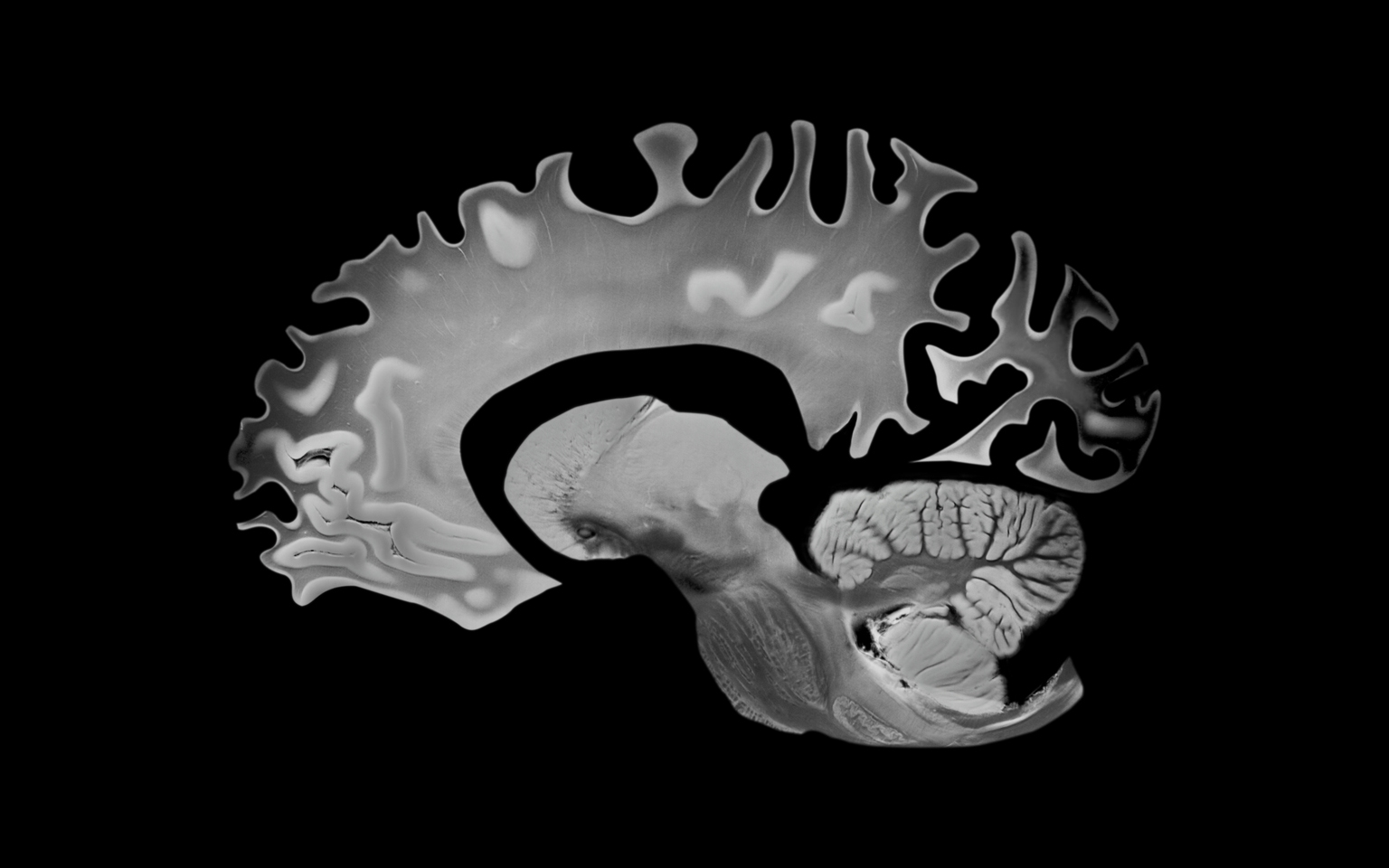 Acumen Pharmaceuticals: A Speculative Buy Ahead Of November's Alzheimer's Readout