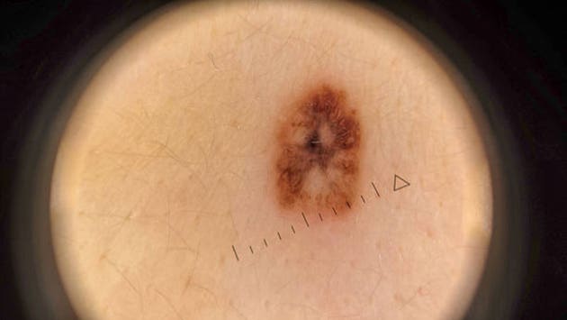 Replimune gains accelerated approval of Tudriqev for cutaneous melanoma