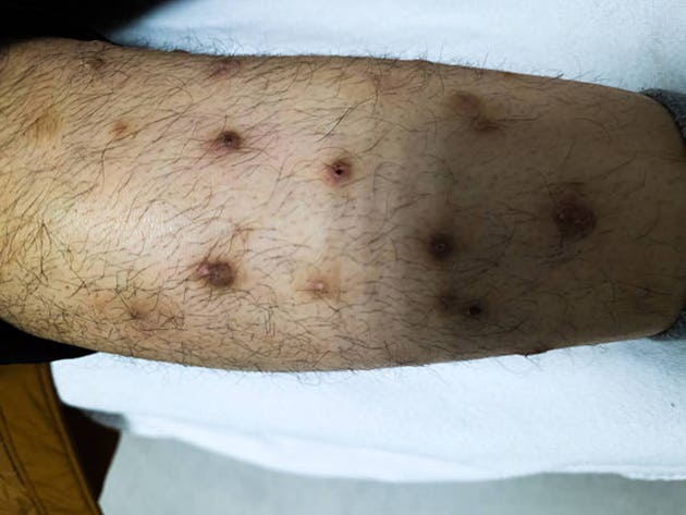 Akcie Celldexu padají po zveřejnění výsledků druhé fáze vývoje barzolvolimabu