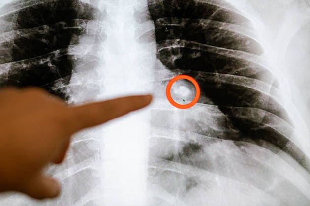 Chest X-ray with Highlighted Area