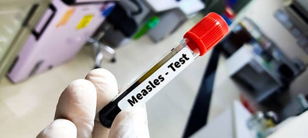 CDC acknowledges one Pennsylvania measles death