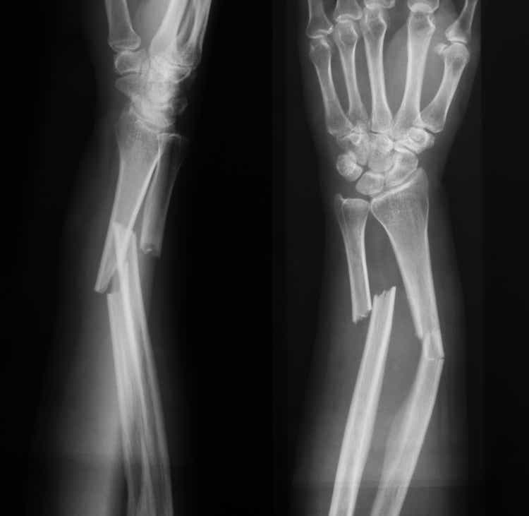 Ultragenyx And Mereo's Setrusumab For Osteogenesis Imperfecta ...