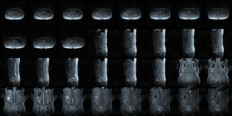 MRI multiple perspective mosaic of lower spinal column ( lumbar spine )