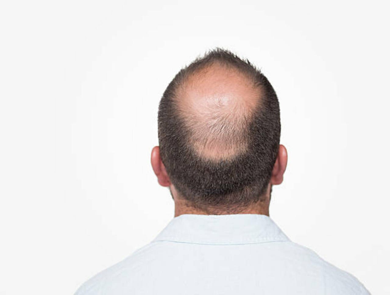 FDA issues warning over compounded finasteride for hair loss | Seeking ...
