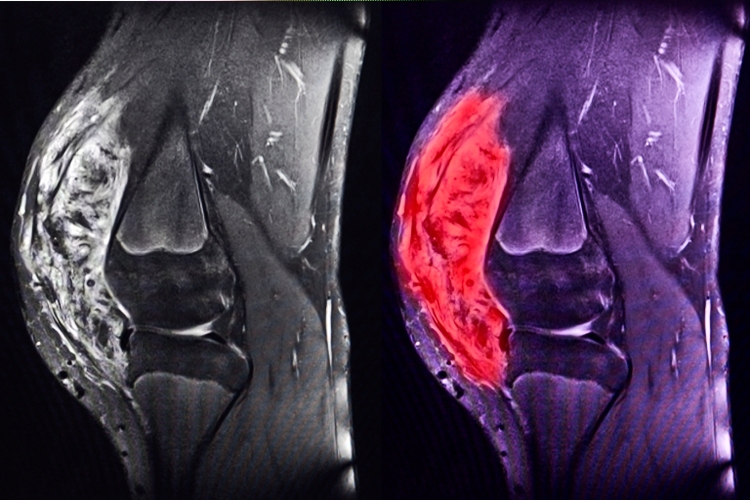 sarcoma of the knee, MRI