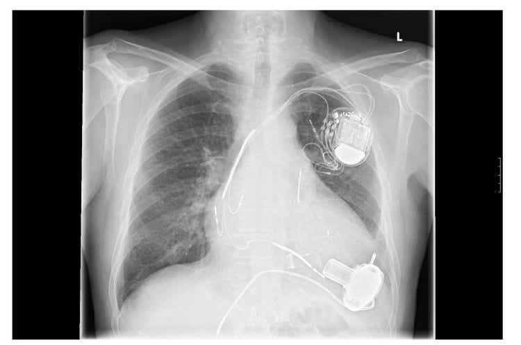 X-ray image, links, artificial heart pacemaker
