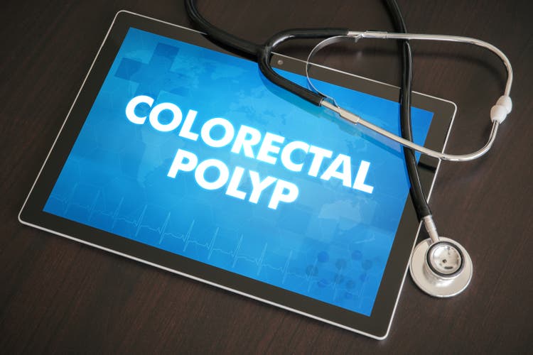 Colorectal polyp (gastrointestinal disease related) diagnosis medical concept on tablet screen with stethoscope