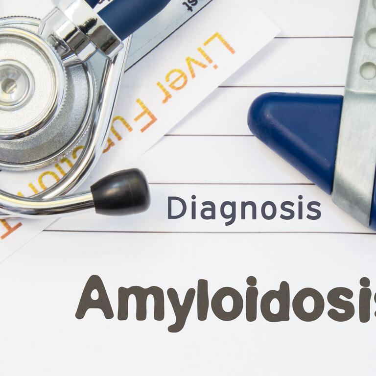 Diagnosis Amyloidosis. Neurological hammer, stethoscope and liver laboratory test lie on note with title of Amyloidosis. Concept for neurology and gastroenterology