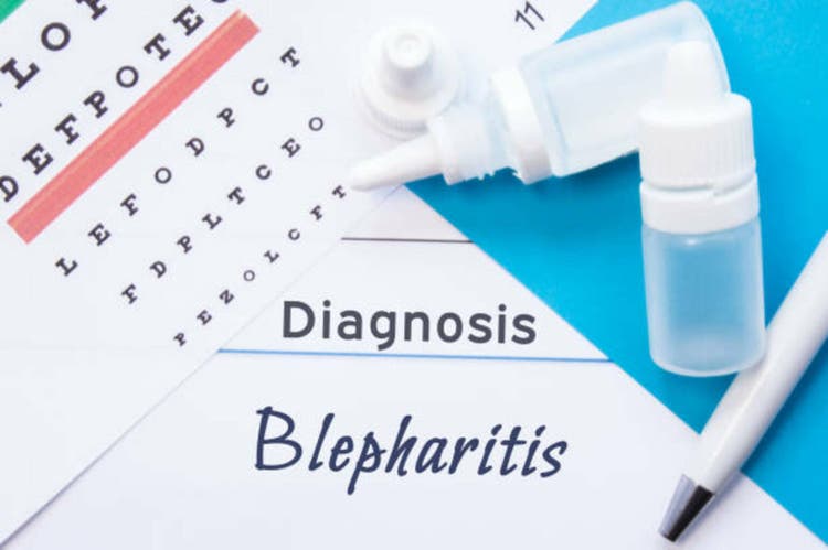 Ophthalmology diagnosis Blepharitis. Snellen (eye) chart, two bottles of eye drops ( medications) lying on notebook with inscription Blepharitis diagnosis on the desk in ophthalmologist office