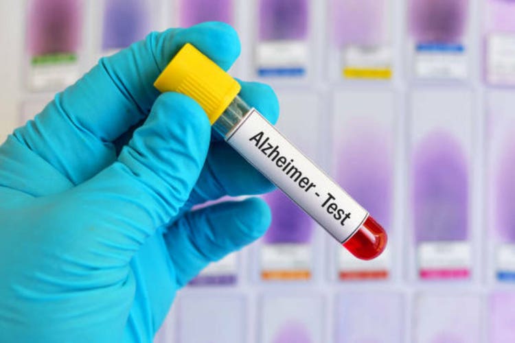 Blood sample for Alzheimer test