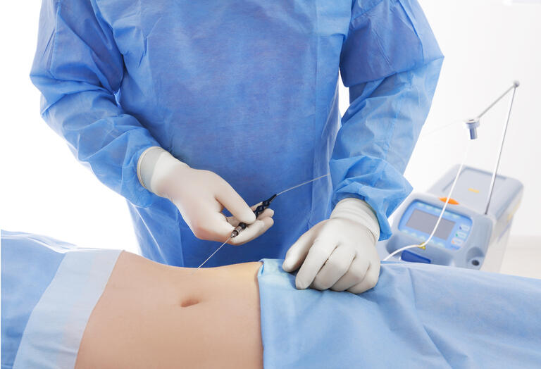 procedure for laser lipolysis of the abdominal region