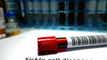 Editas gains as Stifel upgrades on sickle cell disease potential article thumbnail