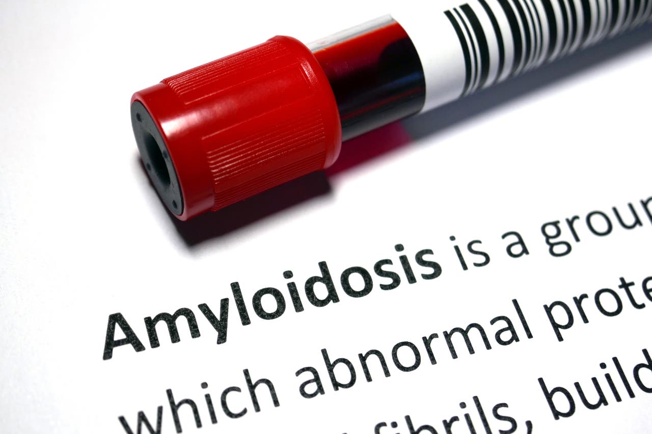 Alnylam to face FDA AdCom meeting on amyloidosis drug Seeking Alpha Alnylam to face FDA AdCom meeting on amyloidosis drug Seeking Alpha