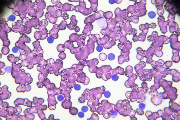 Chronic lymphocytic leukemia (CLL) blood smear under light microscopy